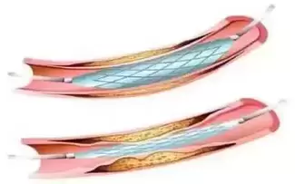 Picture of a Heart Stent Illustration
