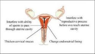 Picture showing cause of ParaGard IUD removal complications